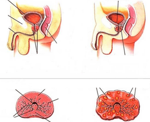 prostate normale et prostatite chronique